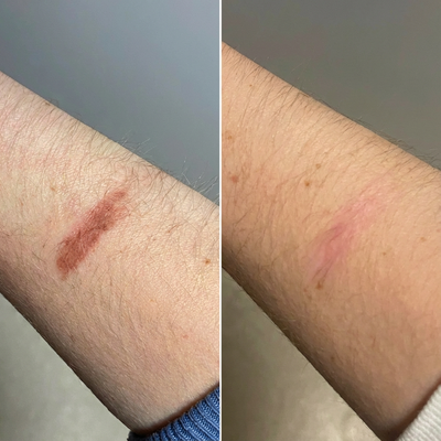 Zeeba Advanced Scar Cream