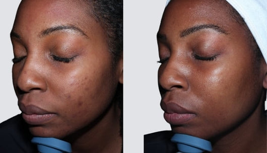 Zeeba Advanced Scar Cream