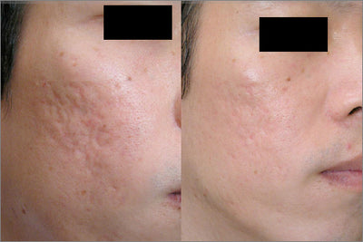 Zeeba Advanced Scar Cream